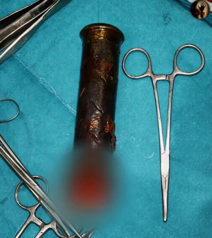 Kisah Tragis di India: Suami Diduga Masukkan Pegangan Motor ke Tubuh Istri Saat Mabuk